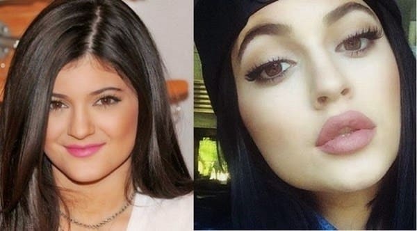 Dr. Yoel Shahar Comments On On Kylie Jenner's Lips | Cosmetic Surgery